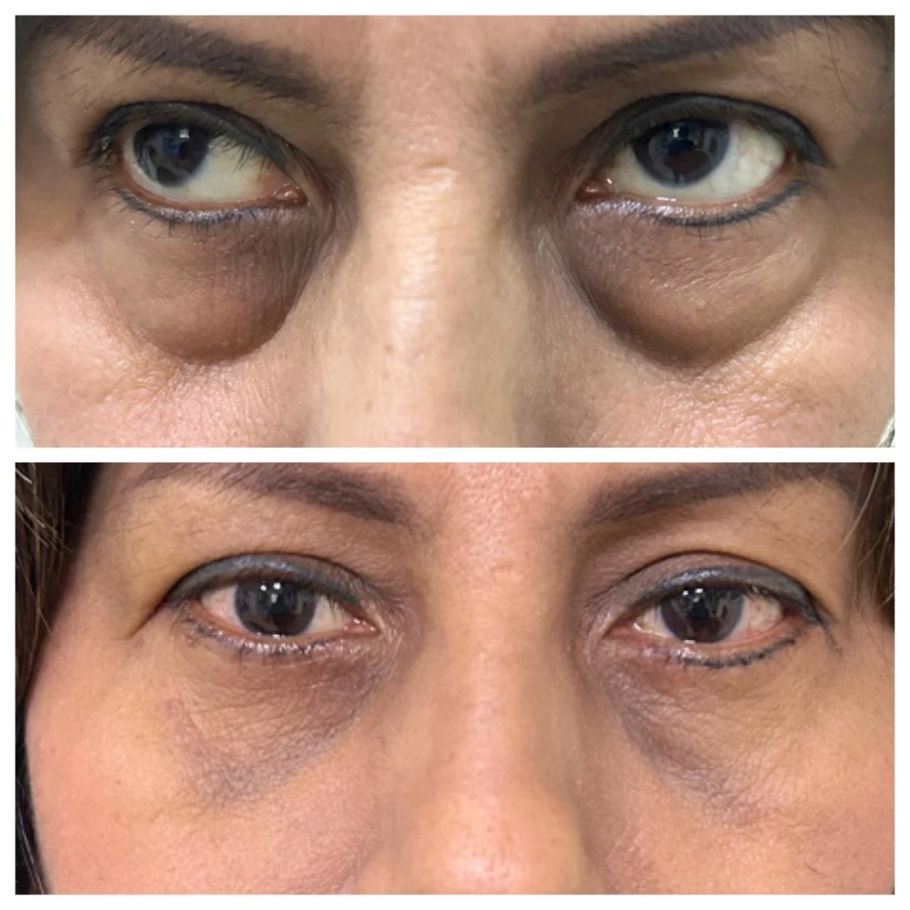 Antes y después de blefaroplastía inferior por bolsas en los párpados — caso real Dra. Martínez