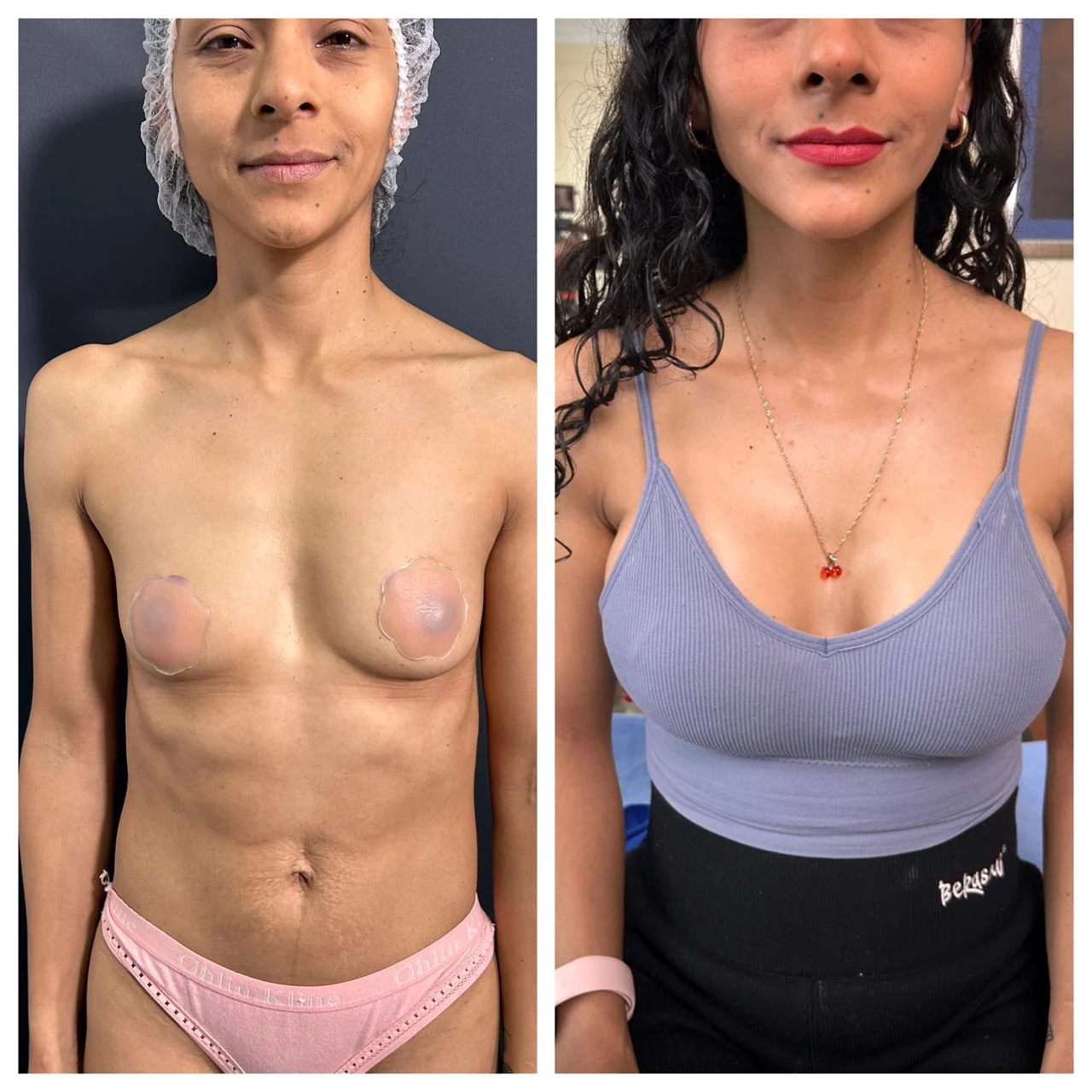 Antes y después de aumento de mamas por poco volumen — caso real Dra. Martínez