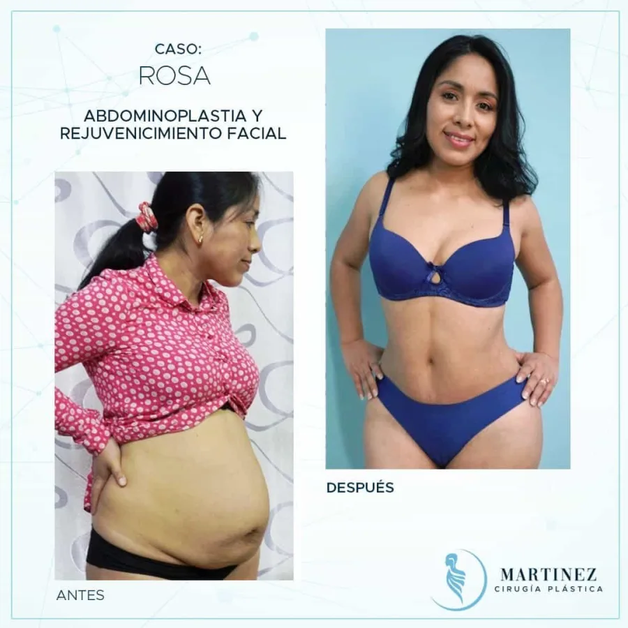 Antes y después de abdominoplastía por diástasis abdominal — caso real Dra. Martínez